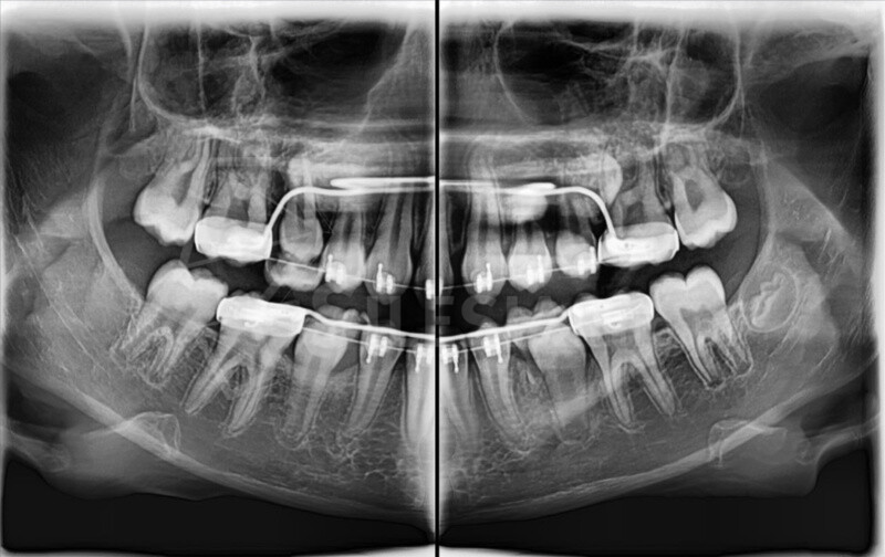 RTG stomatologiczne, CBCT od 100 zł Świętochłowice